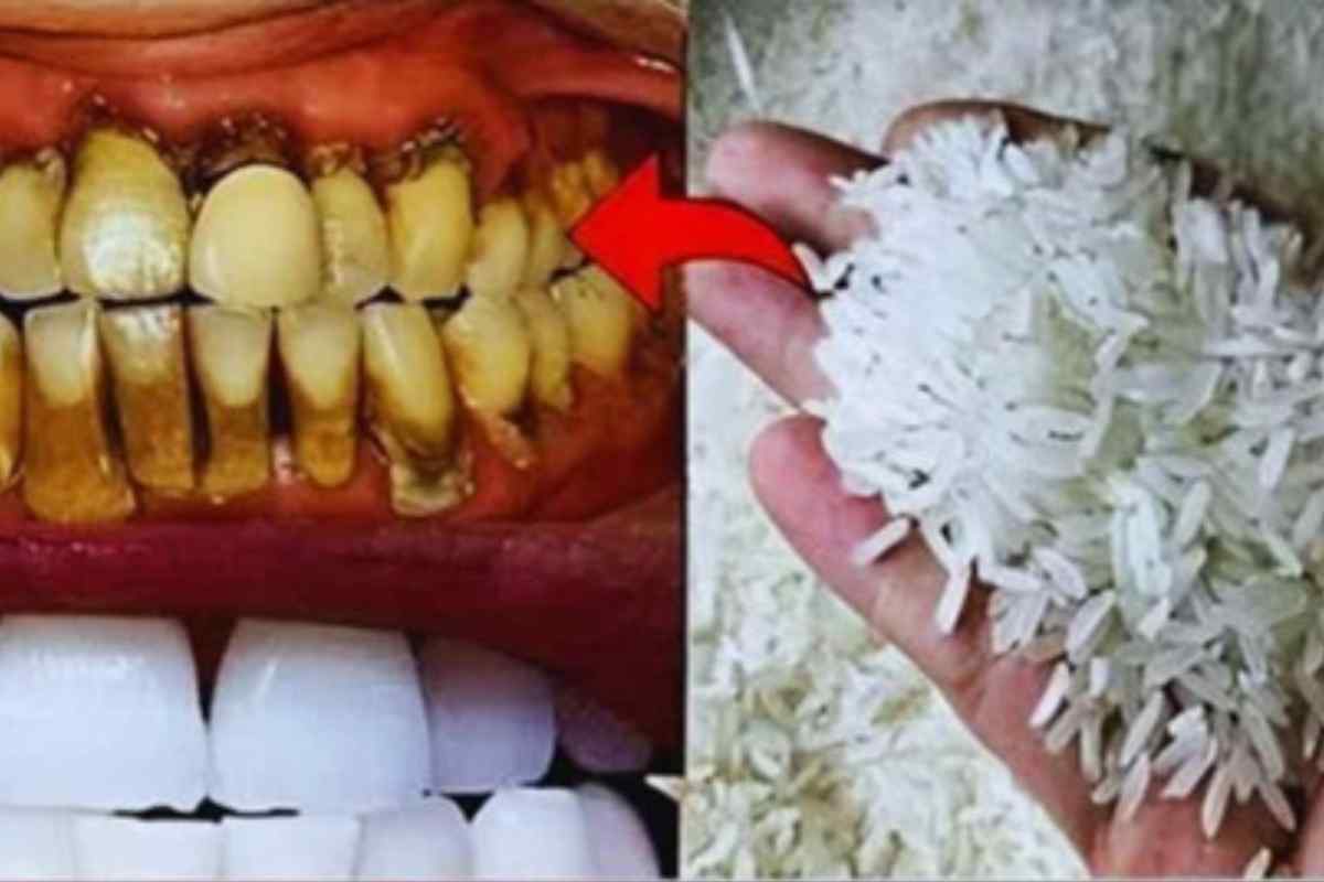 É Melhor Que Lentes nos Dentes! Técnica Simples e Natural