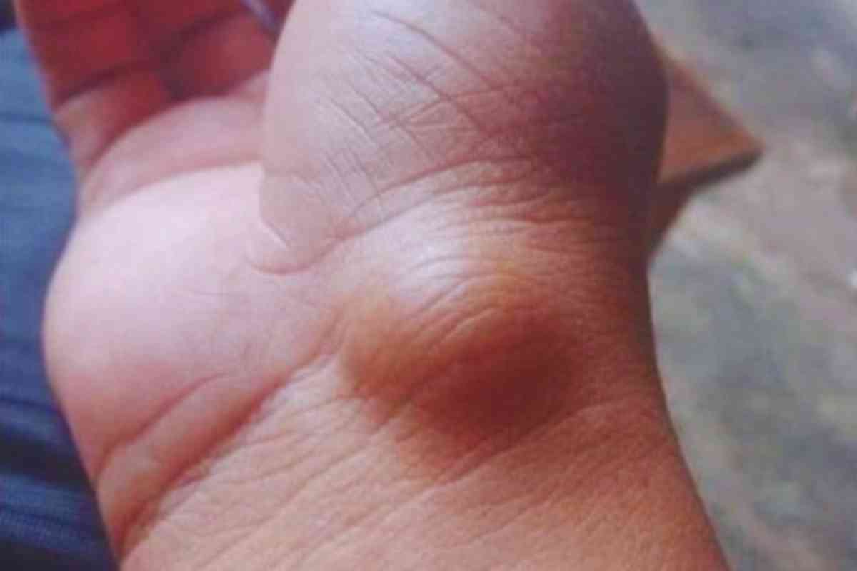 Cisto Sinovial! O Que é, Causas, Tratamento e Quando Procurar Médico
