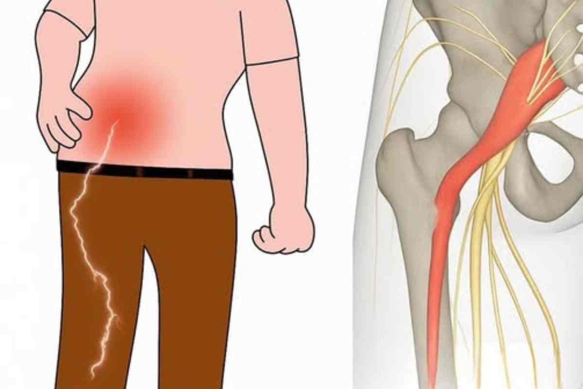 Dor no Nervo Ciático! Exercícios Simples para Aliviar o Desconforto