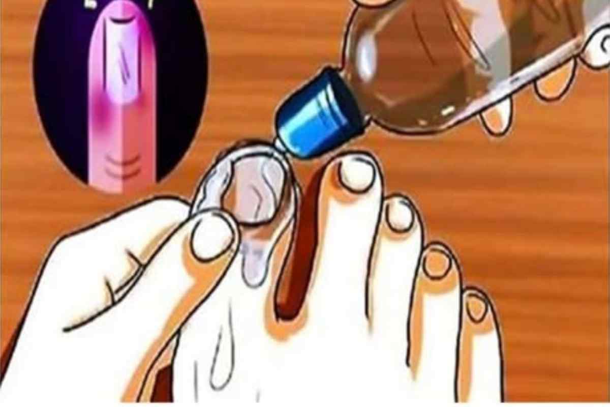 Fungos nas Unhas e nos Pés! o que realmente funciona