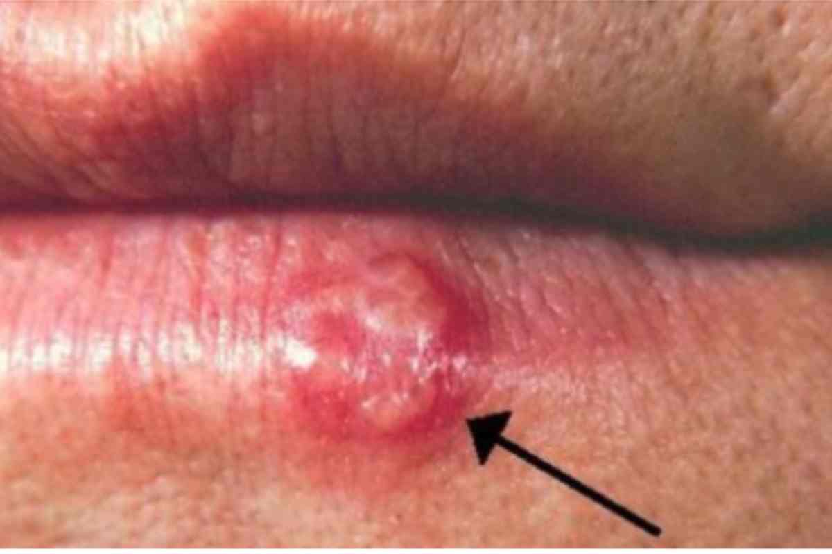 Herpes-Zóster! Sintomas, Causas e Tratamentos