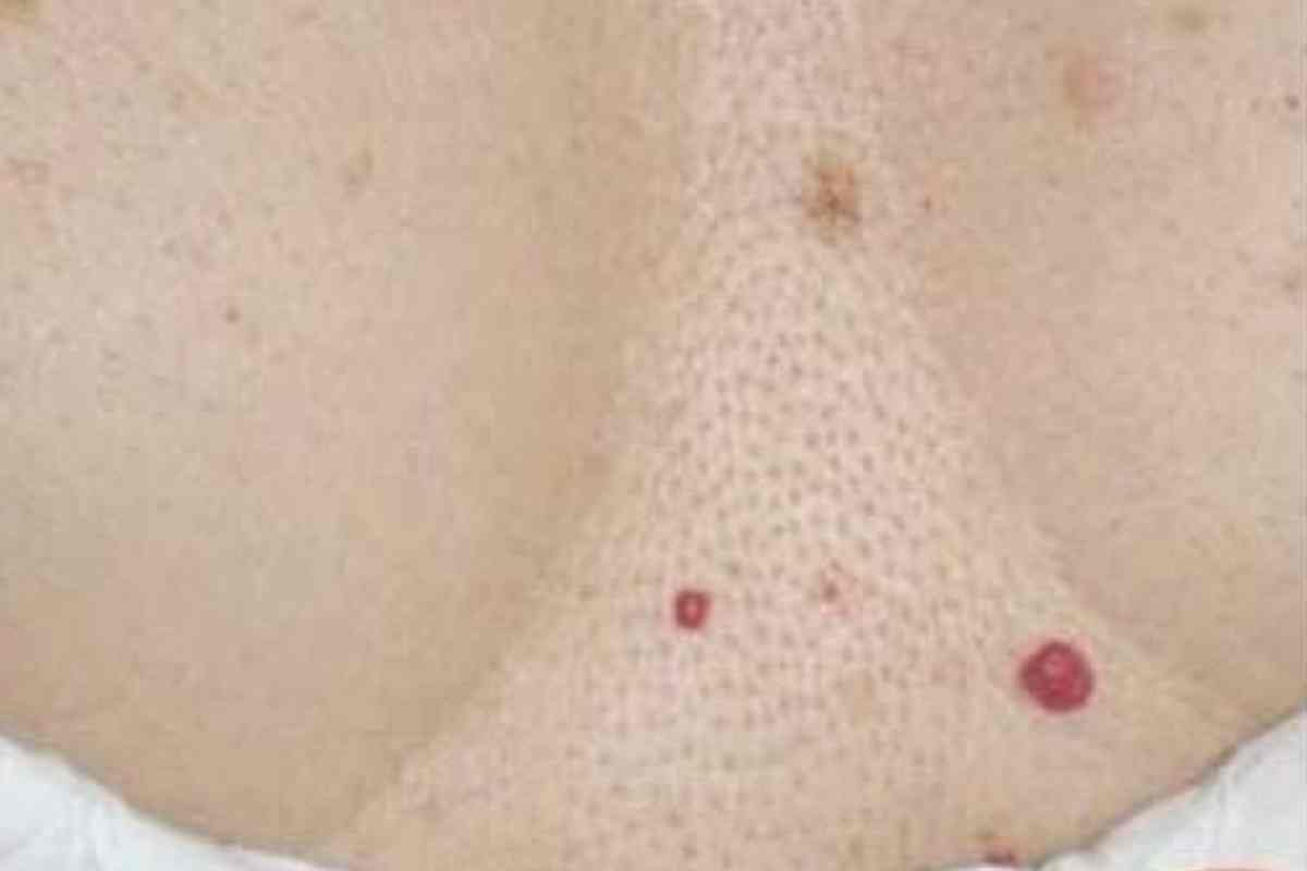 Pontinhos vermelhos no corpo! o que são, quando se preocupar