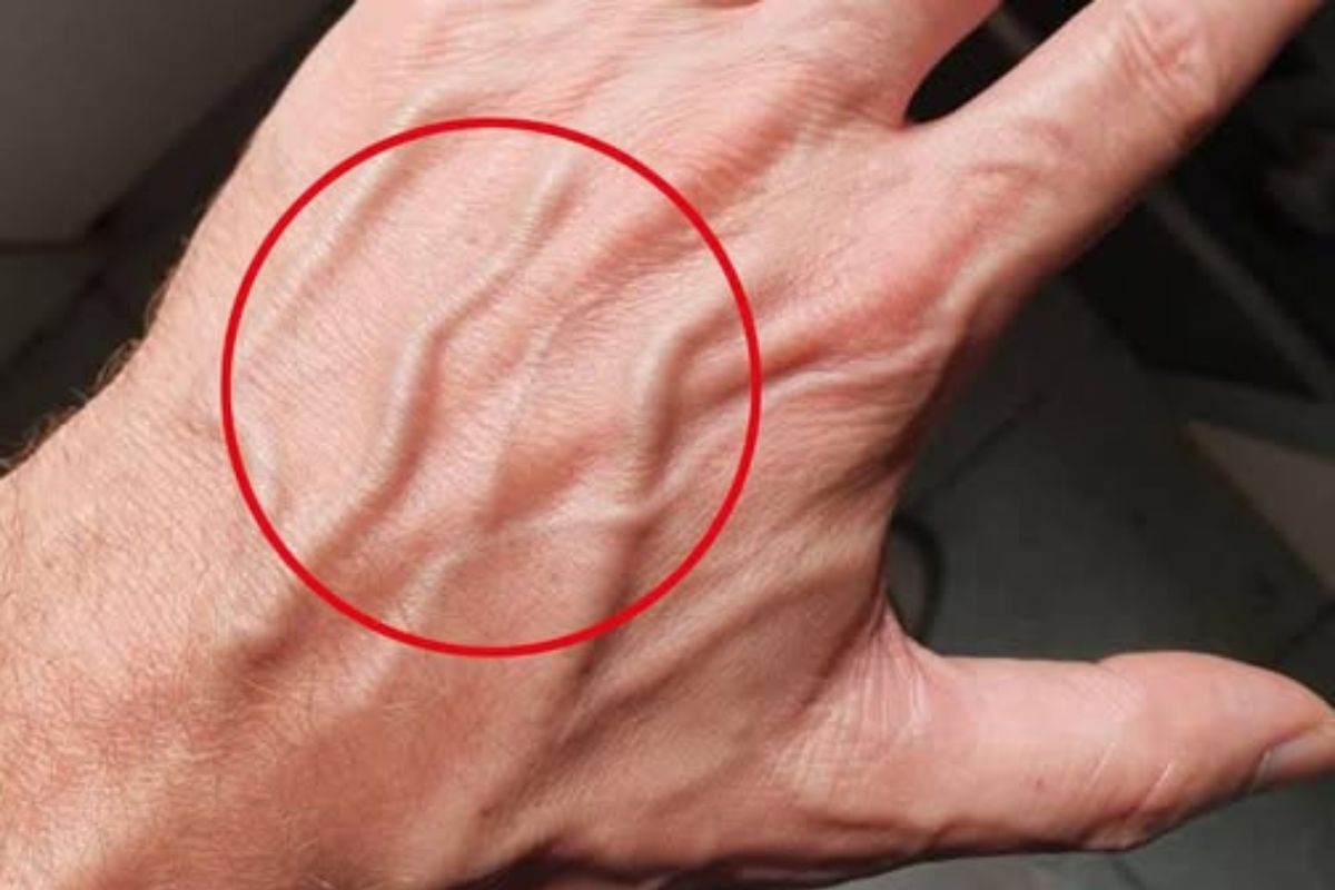 Veias que Aparecem Repentinamente: Quando é Sinal de Alerta?