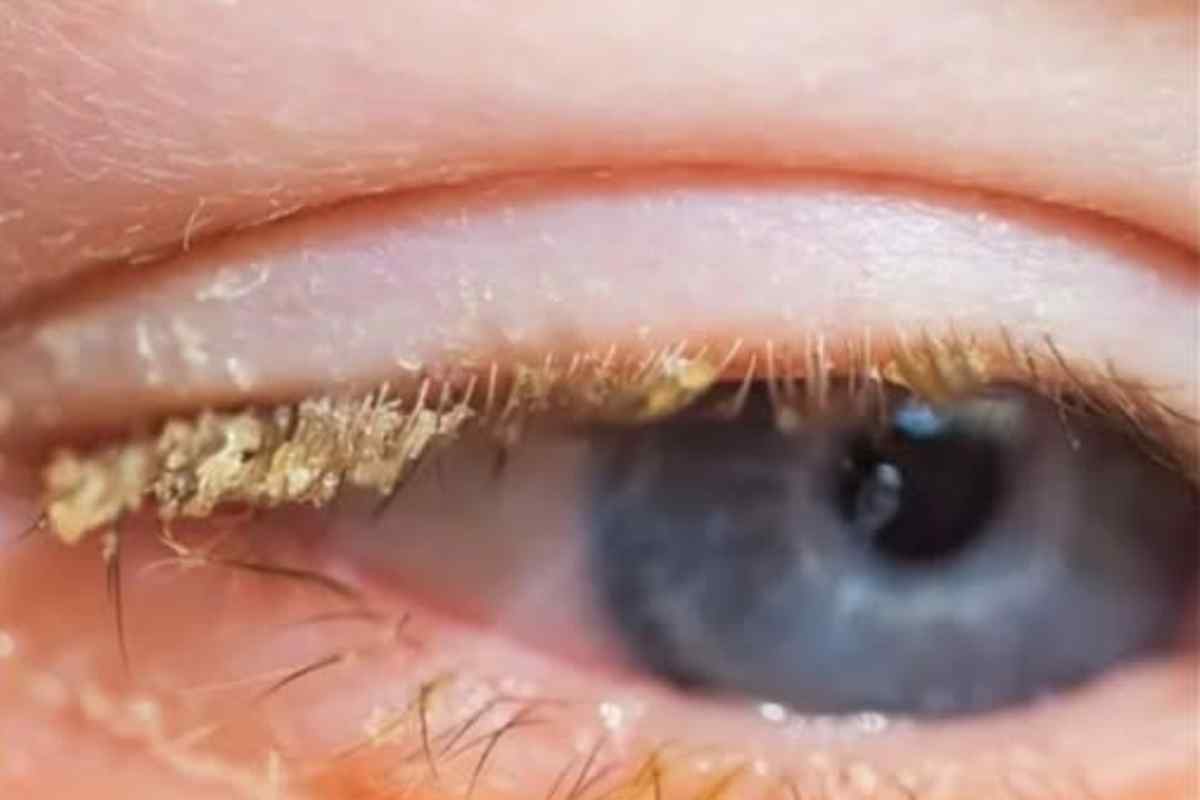 Crosta Amarela no Canto dos Olhos ao Acordar! O Que Isso Significa?
