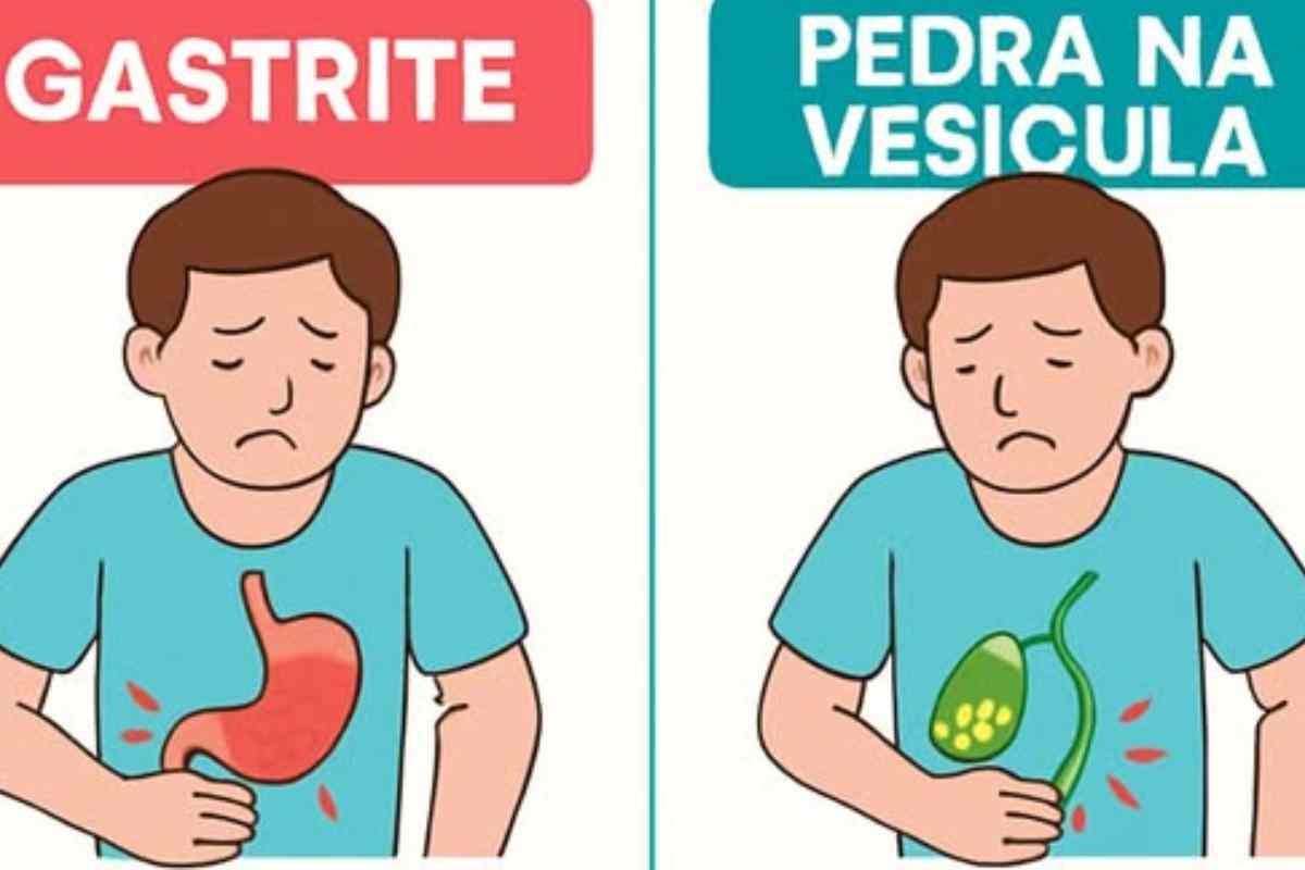 Gastrite ou vesícula? 7 Sinais para diferenciar e quando buscar ajuda médica