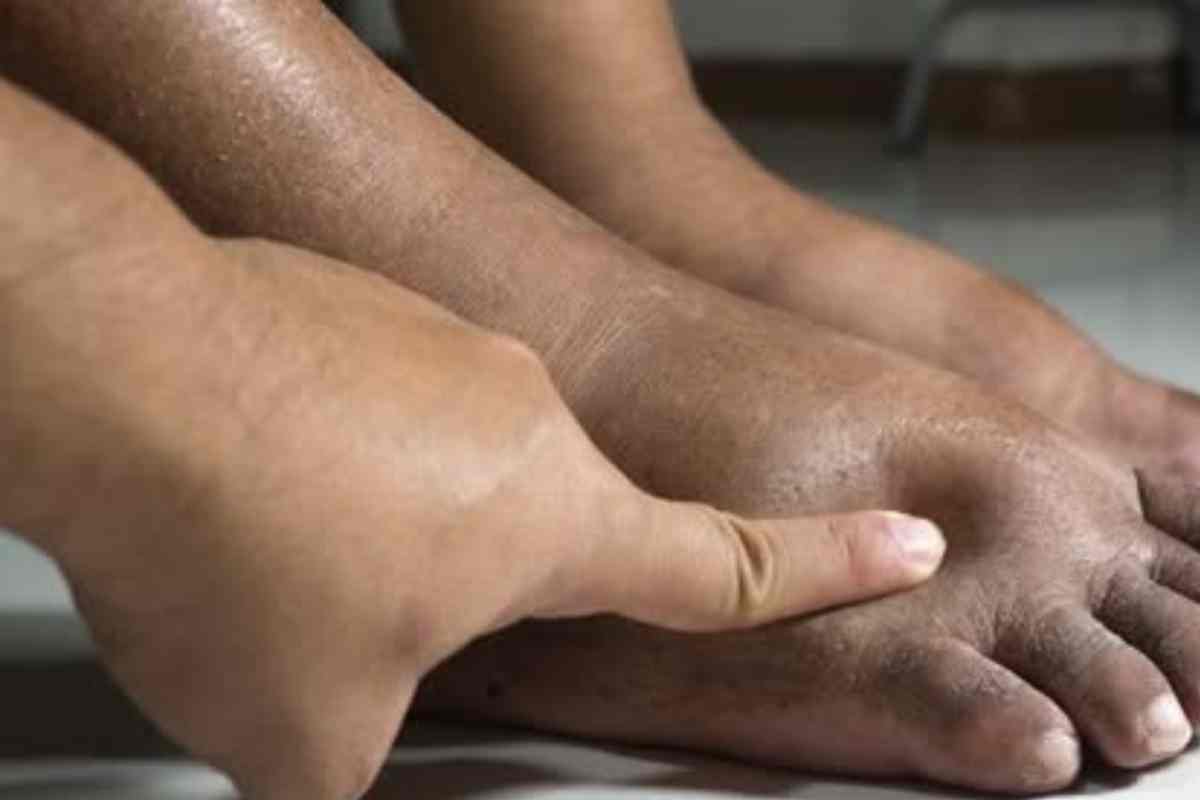 Inchaço nos pés e tornozelos! causas, riscos e alívio natural!