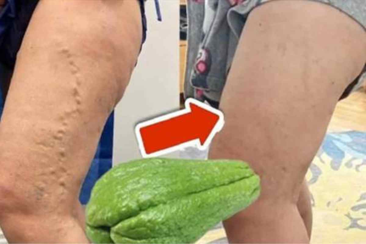 Nenhuma Variz Suporta Chuchu! Elimina Varizes Até em Idosos
