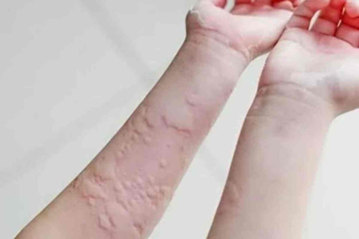 Urticária! Não é Só uma Alergia! 10 Causas Surpreendentes